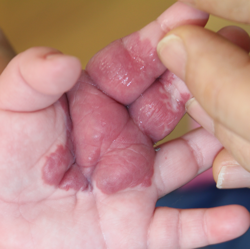 えぬくりブログ: 血管腫