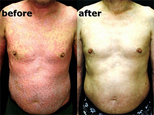 Case_psoriasis_vulgaris_p051